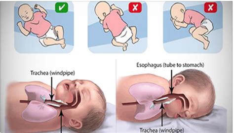 Importante Saber O Que Fazer Para Evitar O S Ndrome De Morte S Bita