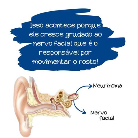 Nervo Facial após Neurinoma Do Acústico e Schwannoma Vestibular