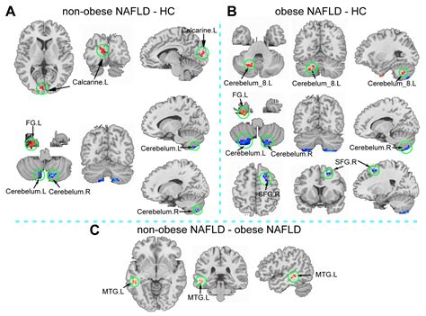 Aberrant Spontaneous Brain Activity And Its Association With Cognitive