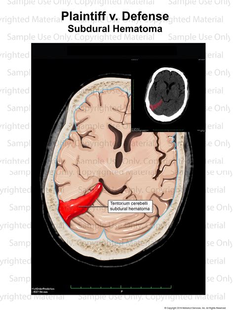 Subdural Hematoma Ct Interp 2 Motionlit