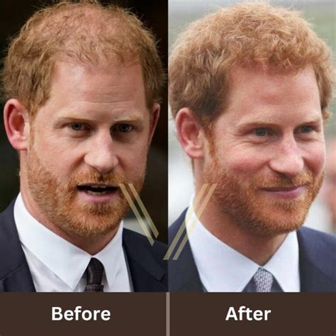 Prince Harry's Hair Transplant: Before and After Transformation