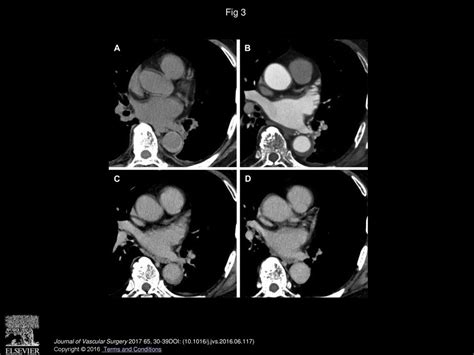 Clinical Importance Of Minimal Enhancement Of Type B Intramural