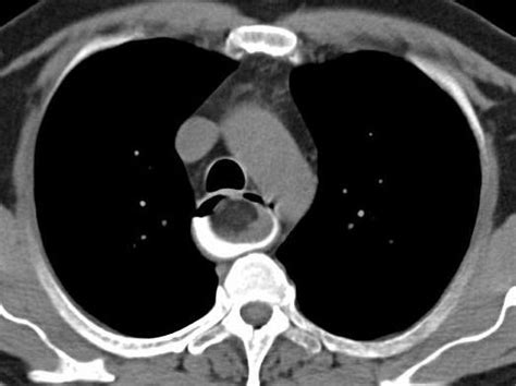 Giant Oesophageal Fibrovascular Polyp Eurorad