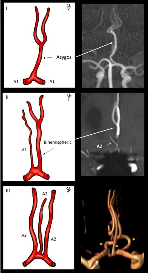 Baptistas Classification For Unpaired Aca The Figure Shows