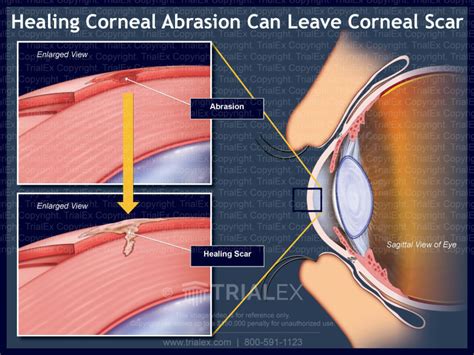 Healing Corneal Abrasion - Sagittal View - Trial Exhibits Inc.