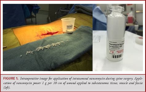 Figure 1 From Does Intrawound Vancomycin Application During Spine