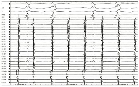 Novel High Density Mapping Techniques For Atypical Atrial Flutter