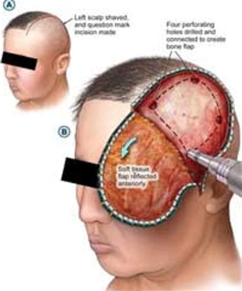 Acute Subdural Hematoma Craniotomy Evacuation Cns Org