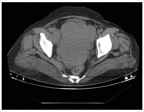 Abdominopelvic Ct A Soft Tissue Mass In The Pelvic Cavity With Right