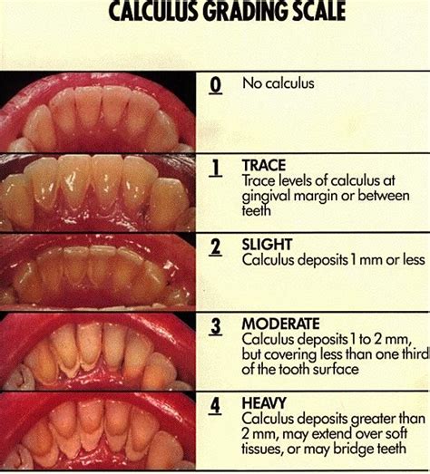 Calculus Teeth Before And After