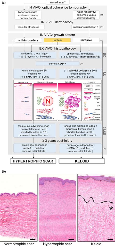 Hypertrophic Scars And Keloids Overview Of The Evidence And Practical