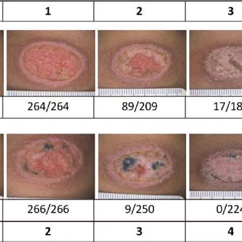 Percent of open lesions versus days of treatment. The graph indicates... | Download Scientific ...