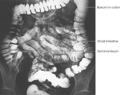 Procedure Small Bowel Lower Gi 3 Flashcards Quizlet