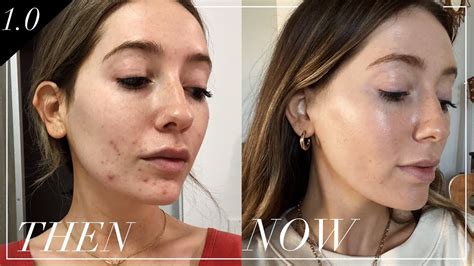 How I Cured My Hormonal Adult Acne Skin Series Youtube