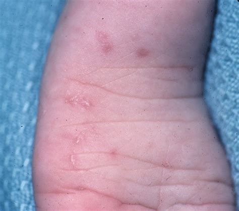 Scabies Treatment Palm Desert Palm Springs Contour Dermatology