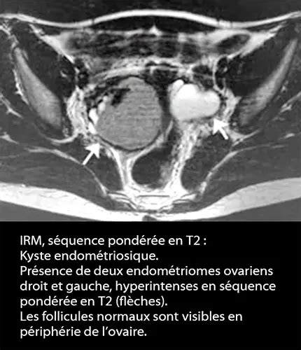 Irm Endometriose Dr Kara Zaitri M A