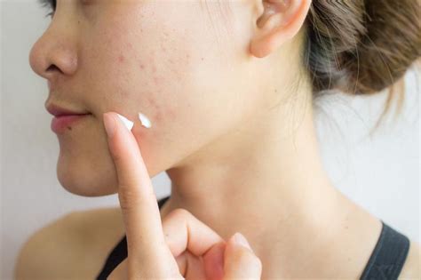 Retinol para el Acné Beneficios Cómo Usarlo y Efectos Secundarios