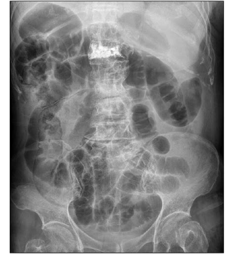 Plain Abdominal X Ray Reveal Multiple Linear Intraluminal Gas Shadow