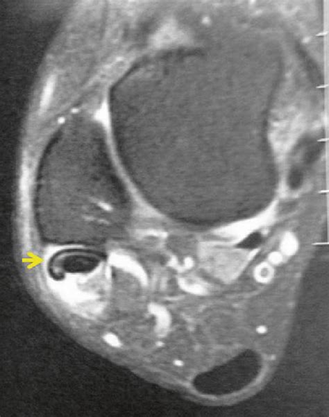 Peroneus Brevis Mri