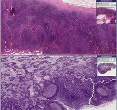 Histopathology Lymph Node Acute Lymphadenitis