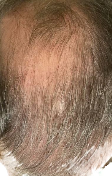 4 Months On Finasteride And Minoxidil Photos Wrassman M D Baldingblog