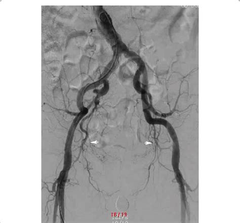 Pelvic Angiogram Showed The External And Internal Iliac Arteries Their