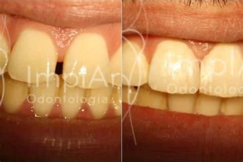 Fechamento Diastema Resina 50kb Implart