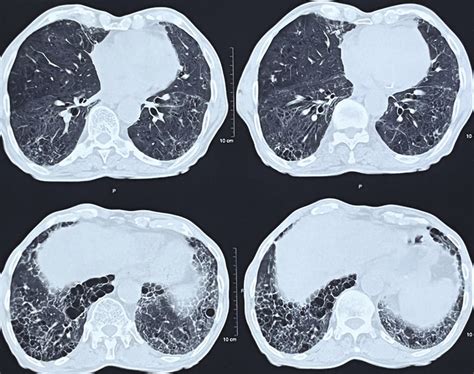 High-resolution computed tomography (HRCT) thorax showing bilateral ...