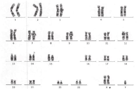 Cytogenetic Analysis Showing An Extra X Chromosome Download Scientific Diagram