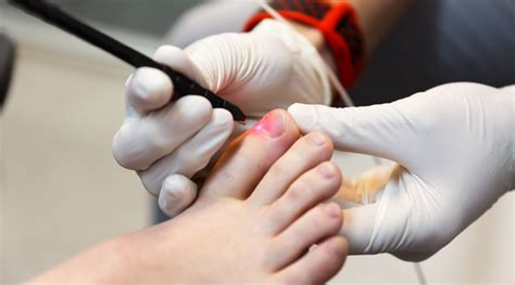 Fungal Nail Laser Treatment Podiatry Care