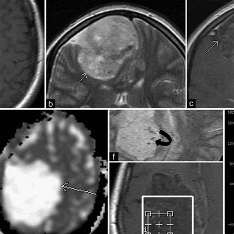 A And B T1 Axial And T2 Coronal Mr Images Showing An Extra Axial