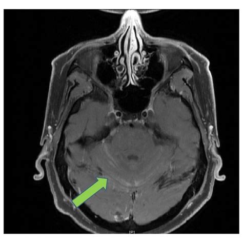 Mri Of The Brain And Orbits Images Show Asymmetric Enhancement Of The Download Scientific