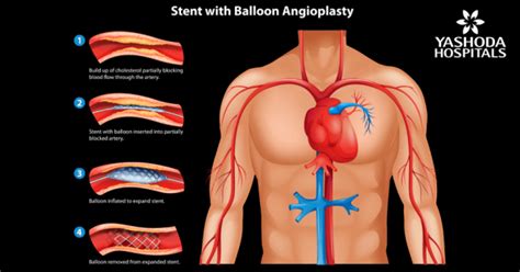 Primary Angioplasty In Myocardial Infarction Best Hospital For