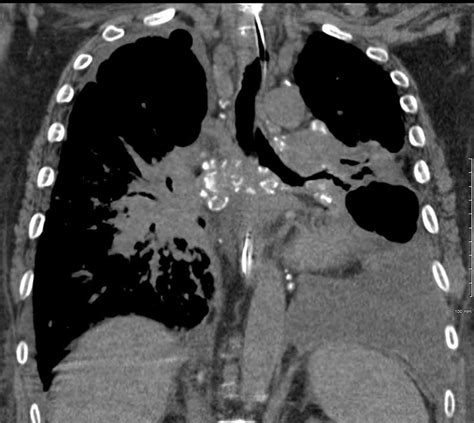 Sarcoidosis Lymph Nodes Lungs