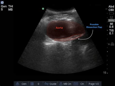 Abdominal Aortic Aneurysm Ultrasound