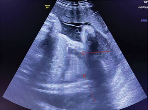 A Nuanced Presentation Of Congenital Pleural Effusion The Chylothorax