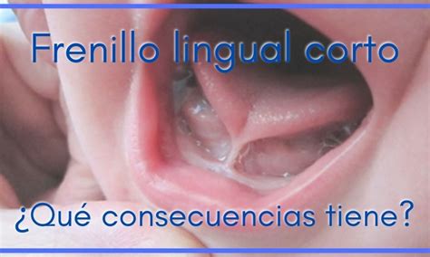 Frenillo Lingual Corto Especialistas