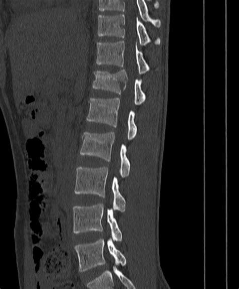 Spinal Compression Fracture Radiology Reference Article Radiopaedia Org