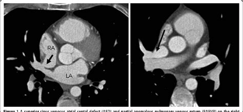 Partial anomalous pulmonary venous return and atrial septal defect in ...