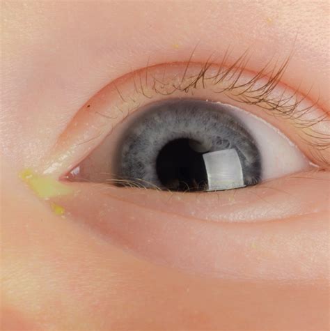 Conjunctivitis in Children: Symptoms and Treatments