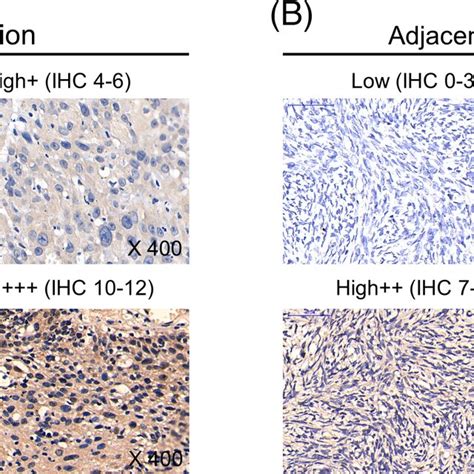 Representative Ihc Staining Samples Of Eif3b Expression In Tumor Tissue