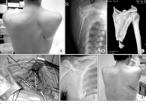 Figure From Treatment Of Scapula Fractures Of The Inferior Angle