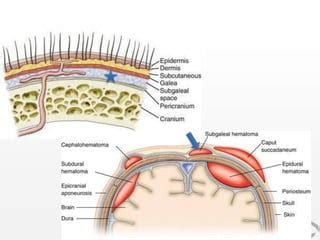 Hematoma subgaleal | PPT