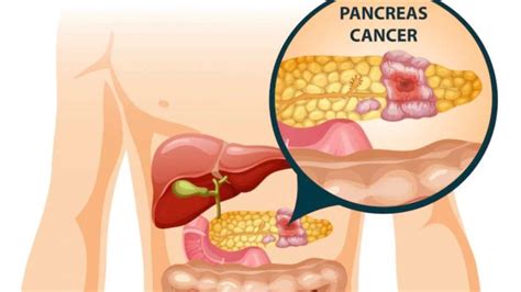 Inflammation In The Pancreas Cause Symptoms And Preventation