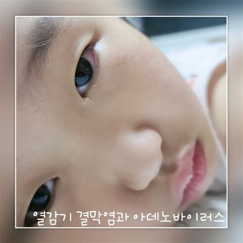 아이 결막염 증상 아데노바이러스와 다른점 심한눈꼽 소아과에 가다 네이버 블로그