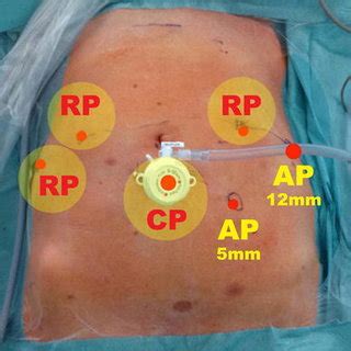 Transperitoneal Six Port Approach Four Arm Robotic Setting With The