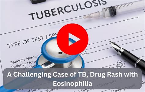 A Challenging Case Of Tb Drug Rash With Eosinophilia