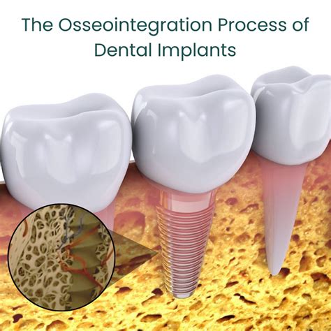 What Is Osseointegration Riverside Oral Surgery