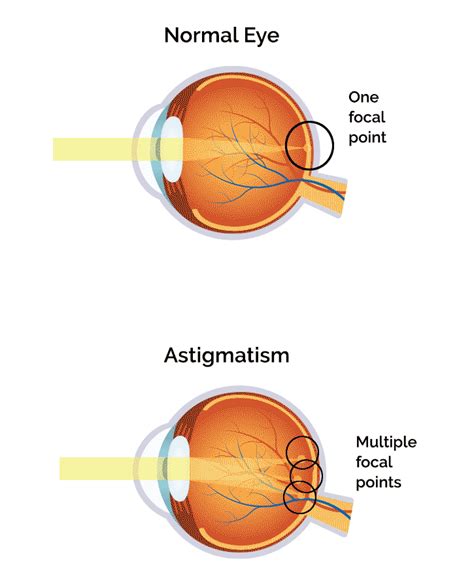 Astigmatism Diagnosis Treatment In Thornton Best Eyecare Associates