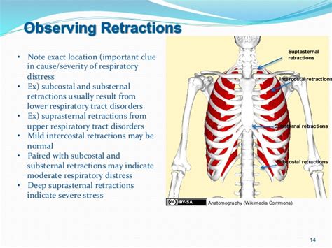 intercostal retractions - USA News Collections